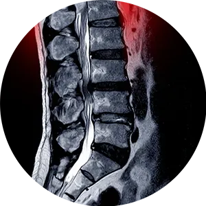 Spinal Neuropathy Treatment Post Falls ID Near Me